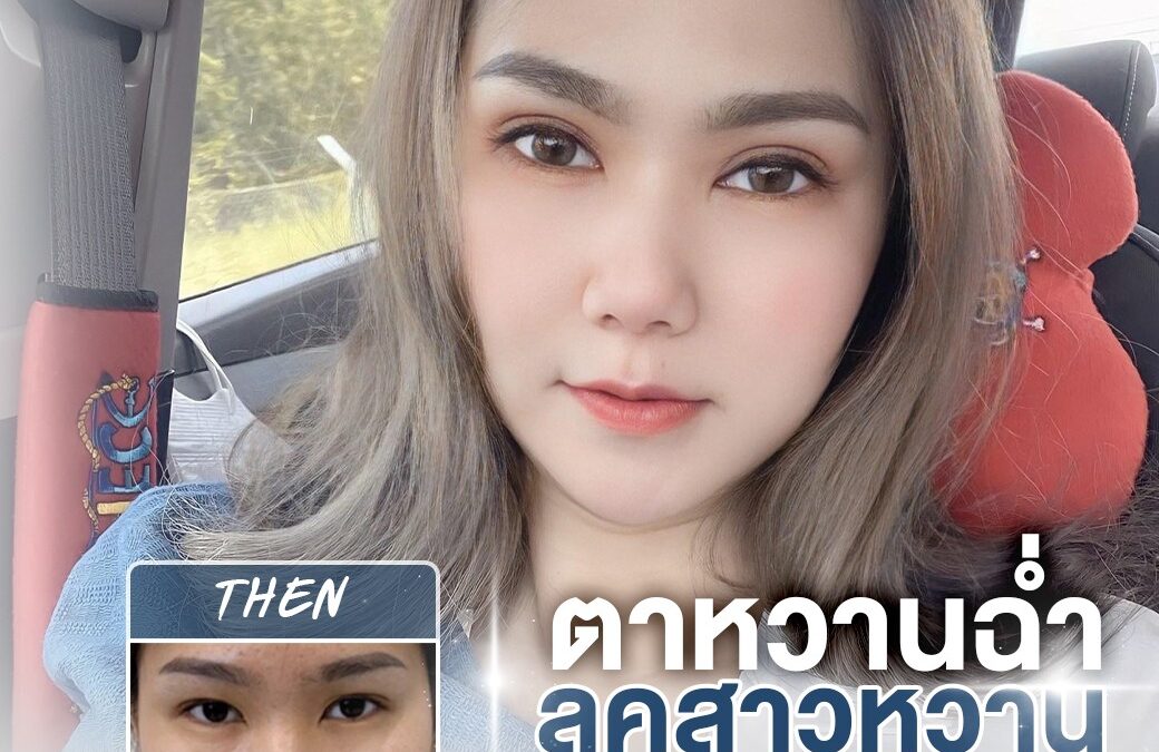 แชร์เคล็ดลับลดบวม หลังศัลยกรรมตาสองชั้น วิธีที่ง่ายและปลอดภัย