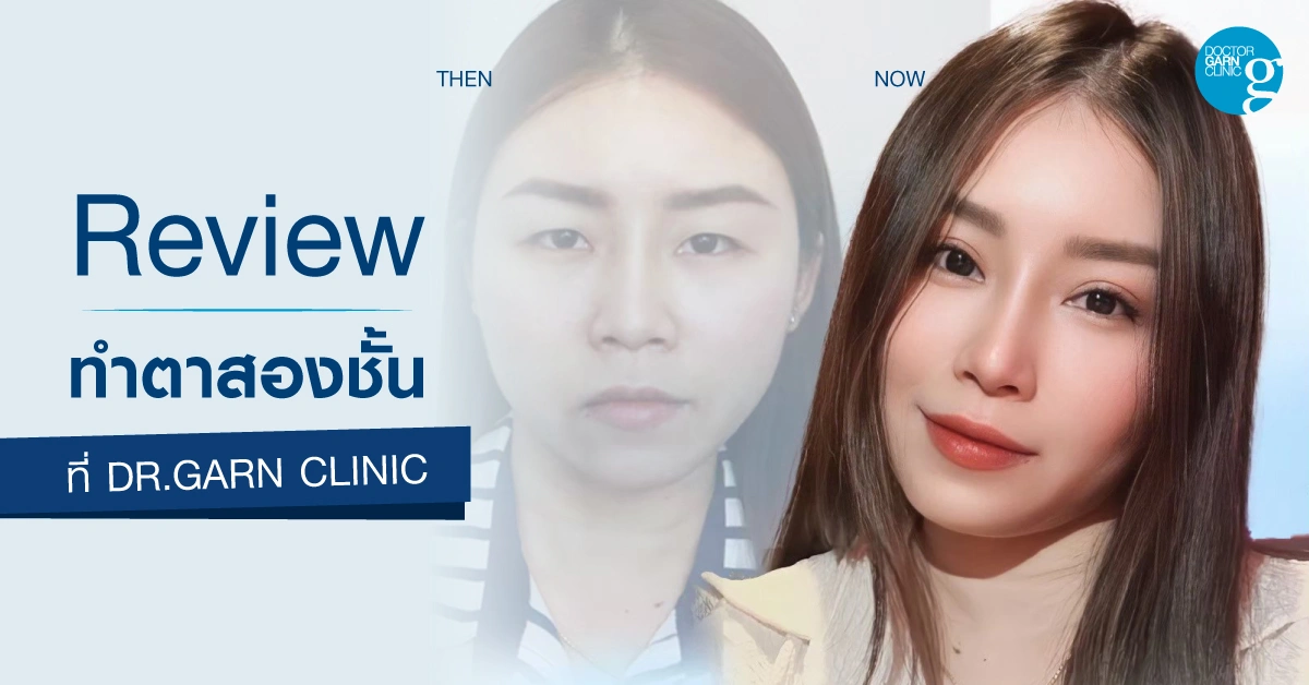 รีวิวทำตาสองชั้น แก้ชั้นตาหลบใน dr.garn clinic