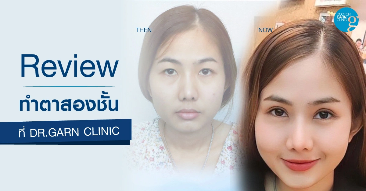 รีวิวทำตาสองชั้น แก้ชั้นตาหลบใน dr.garn clinic