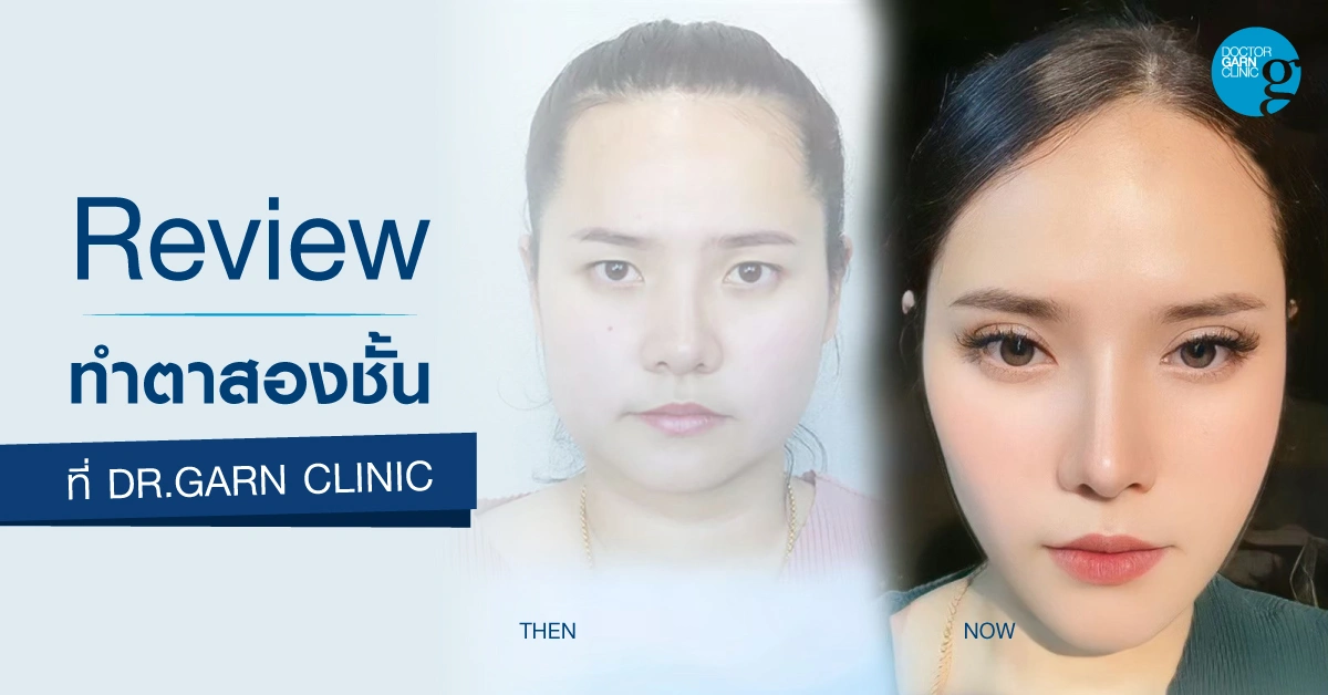 รีวิวทำตาสองชั้น แก้ชั้นตาหลบใน dr.garn clinic