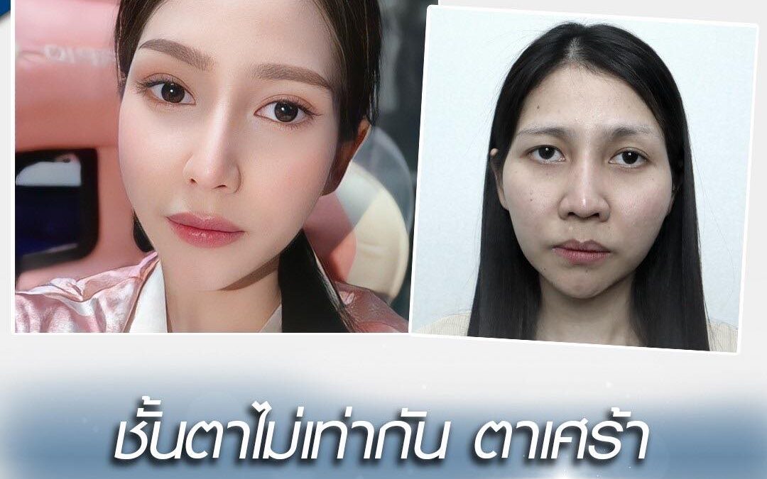 รีวิวตาสองชั้น  เปิดหัวตา