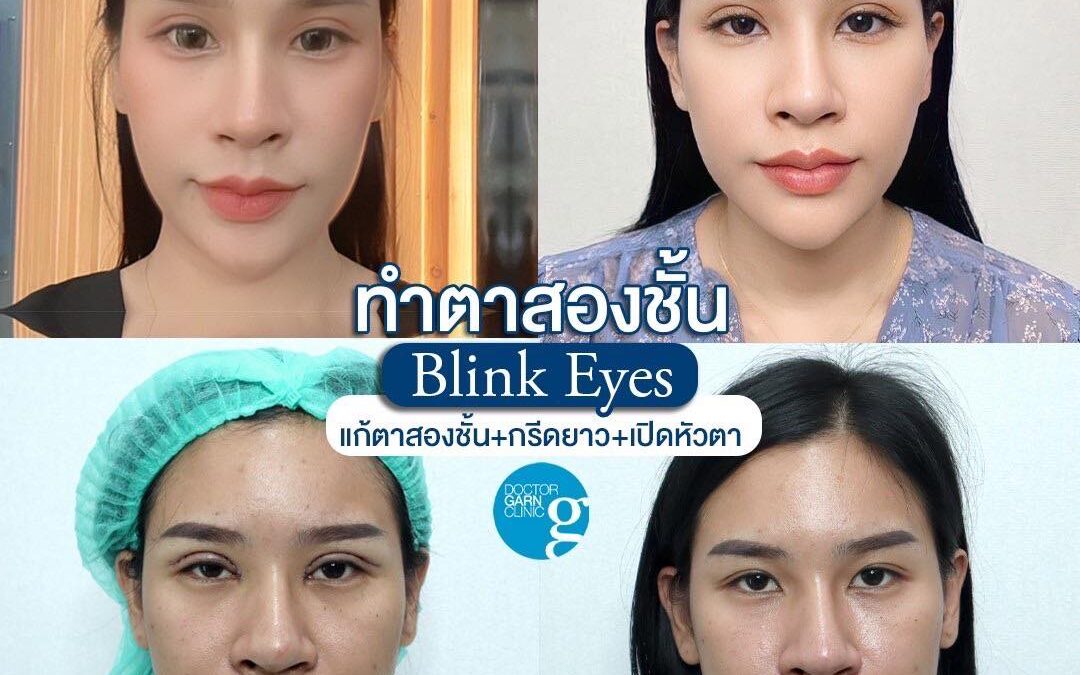 รีวิวแก้ตาสองชั้น+เปิดหัวตา Blink Eyes